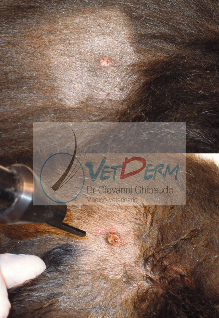 Adenoma sebaceo con laser CO2